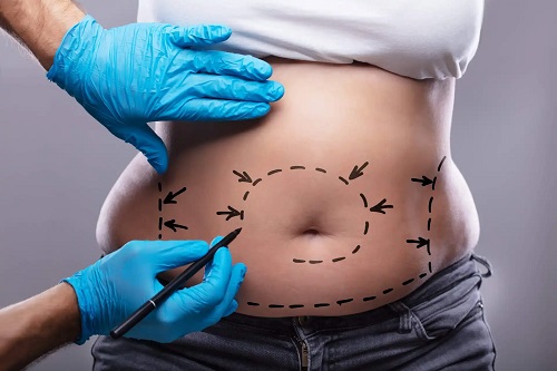 Beneficiile tehnologiei BodyTite pentru abdomen