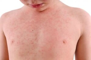 Exantemul subit sau roseola infantum: ce este și cum se tratează?