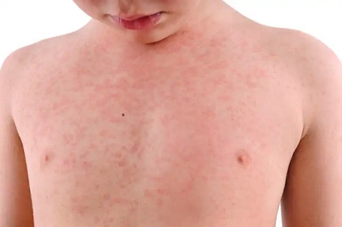 Exantemul subit sau roseola infantum: ce este și cum se tratează?