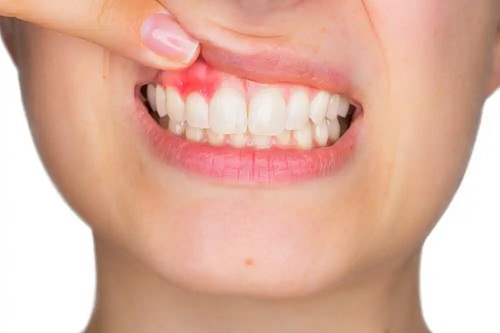 Femeie cu gingivită