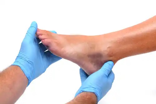 Gleznele și picioarele umflate: cauze și prevenție