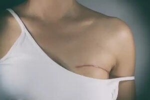 Tipuri de intervenții chirurgicale în tratamentul cancerului de sân