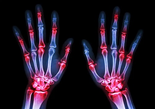 Radiografie a mâinilor