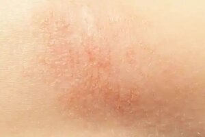 7 remedii naturale pentru pielea uscată