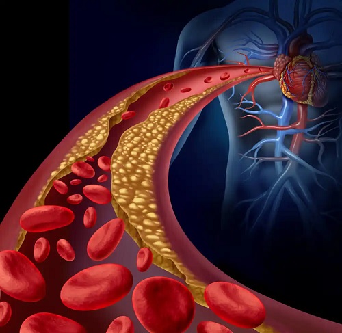 Colesterol care se depune pe un vas de sânge