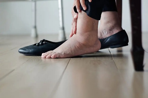 Persoană care are nevoie de artrodeza piciorului