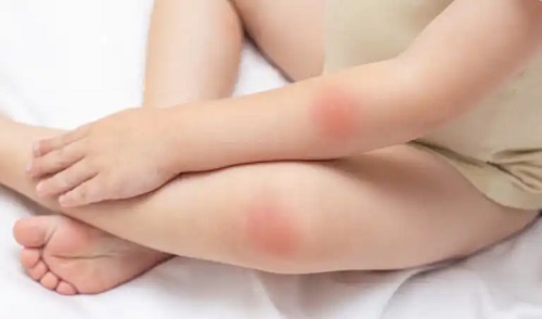 Petele roșii pe piele: 25 de cauze și tratamente
