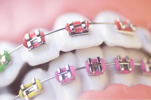 Aparat dentar de corecție
