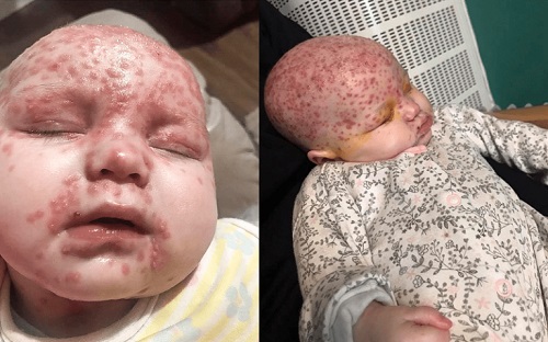 Bebeluș de 6 luni infectat cu herpes din cauza unui sărut