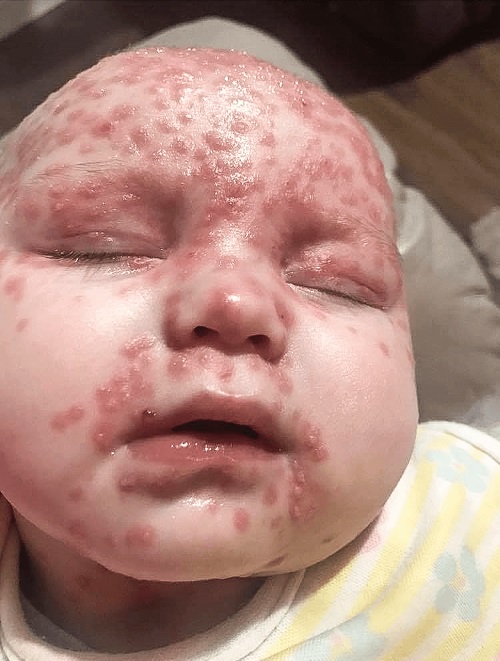 Bebeluș infectat cu herpes