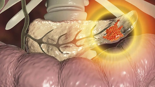 Cancer de pancreas