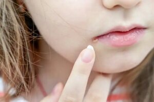 Cum se face diferența între un coș și herpesul labial?