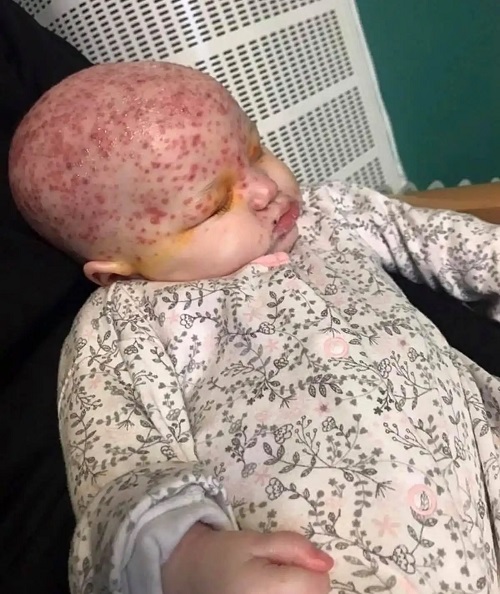 Fetiță cu herpes