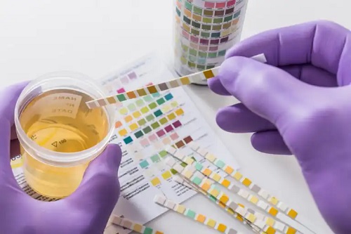 Grăsimea în urină: cauze posibile și ce trebuie făcut