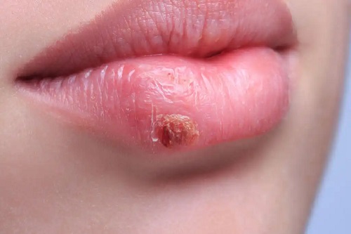 Herpes pe buze