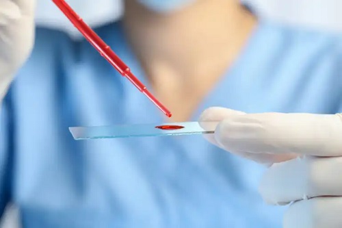 Leucemia eozinofilă cronică: simptome, diagnostic și tratament