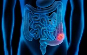 Cercetătorii au descoperit celulele care duc la recidivă în cancerul de colon