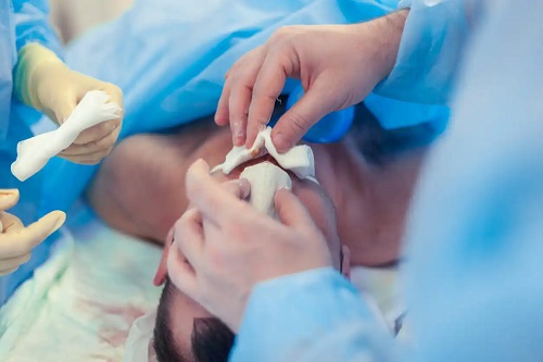 Rinoplastie tradițională