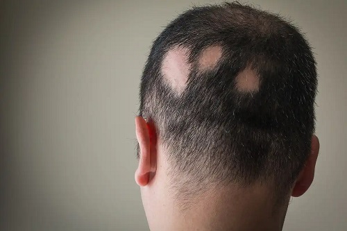 Șamponul CBD și beneficiile lui în alopecie