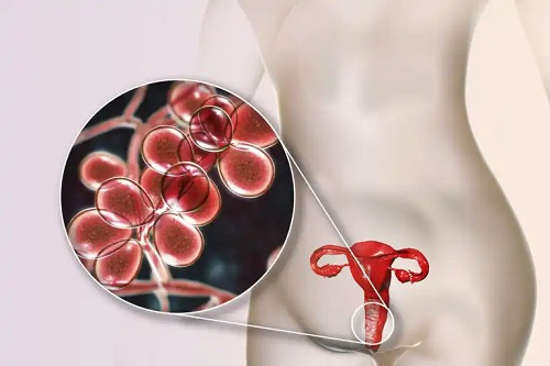 Secrețiile vaginale galbene cu și fără miros: 5 cauze și tratament