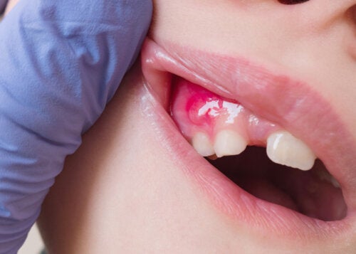 Ce este fistula dentară și cum poate fi tratată?