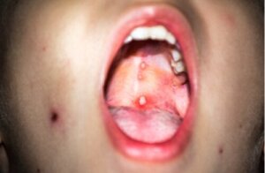 Gingivostomatita la copii: ce este și cum să acționăm?