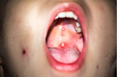 Gingivostomatita la copii: ce este și cum să acționăm?