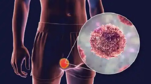 Teratom: tipuri, simptome și tratamente