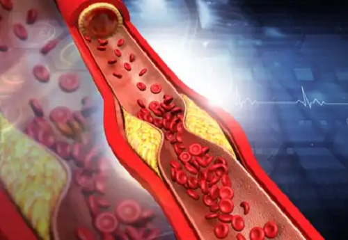 Simptome și sfaturi pentru a crește colesterolul HDL