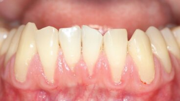 Ce sunt gingiile în retragere și de ce apar ele?